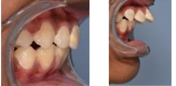 חותכות עליונות בולטות