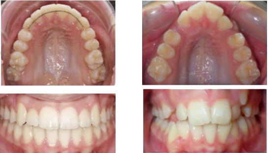 קשת עליונה מוצרת ומשולשת