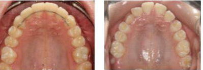 קשת עליונה מרווחת