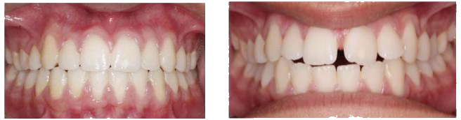 רווח בין שיניים קדמיות